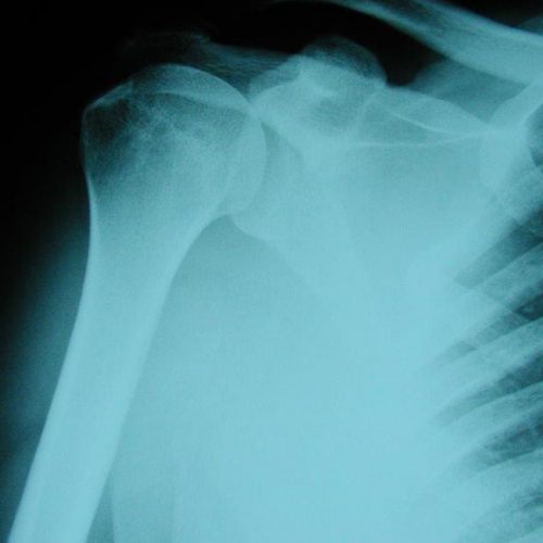 ΡΗΞΗ ΠΕΤΑΛΟΥ ΣΤΡΟΦΕΩΝ (ROTATOR CUFF)