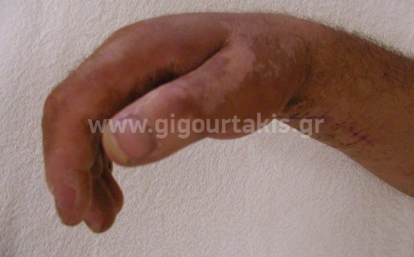02.ΑΡΧΙΚΗ ΚΑΜΨΗ ΔΑΚΤΥΛΩΝ 17