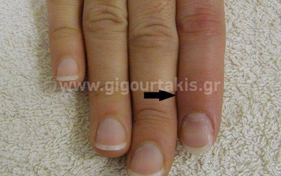 03.ΡΗΞΗ ΕΚΤΕΙΝΟΝΤΟΣ ΠΑΡΑΜΟΡΦΩΣΗ MALLET FINGER