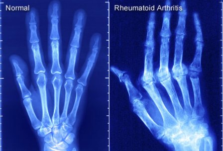 Rheumatoid arthritis: hand exercises
