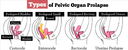 types of pelvic organ prolapse