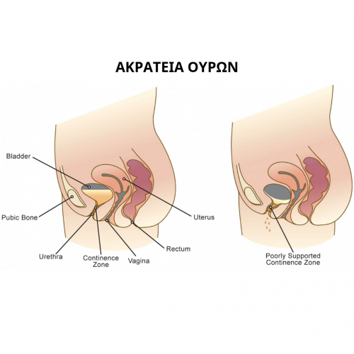 Ακράτεια Ούρων και Φυσικοθεραπευτική Παρέμβαση