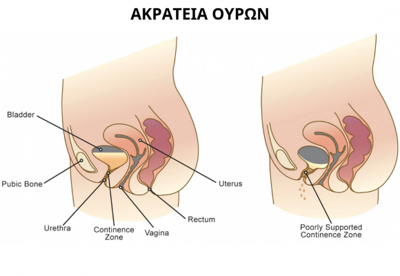 Ακράτεια Ούρων και Φυσικοθεραπευτική Παρέμβαση