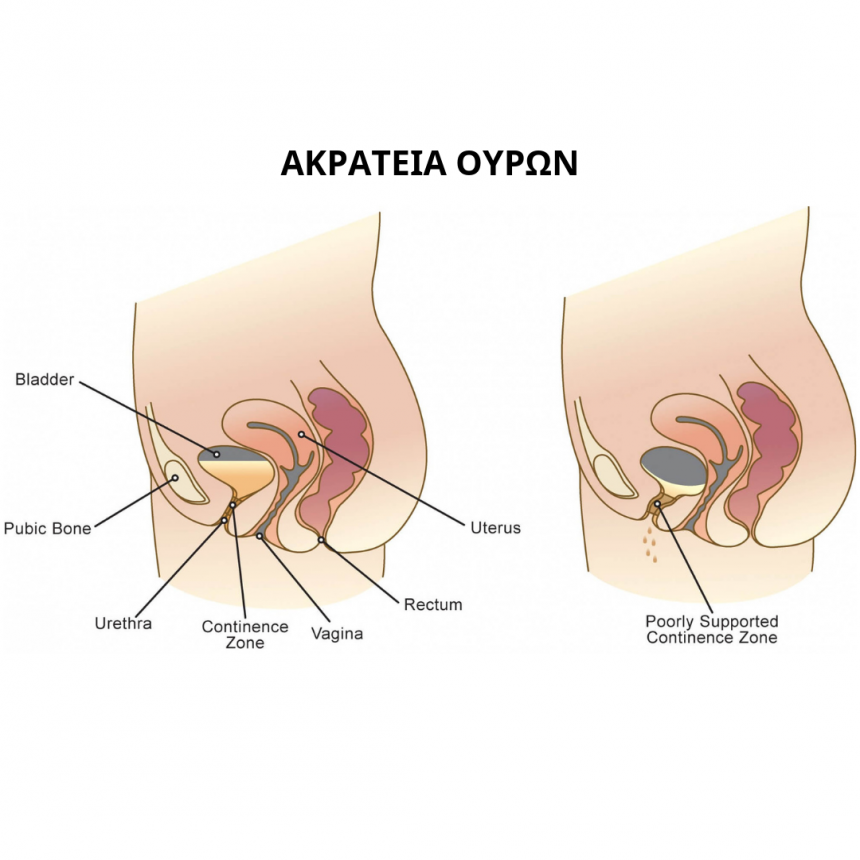 Ακράτεια Ούρων και Φυσικοθεραπευτική Παρέμβαση