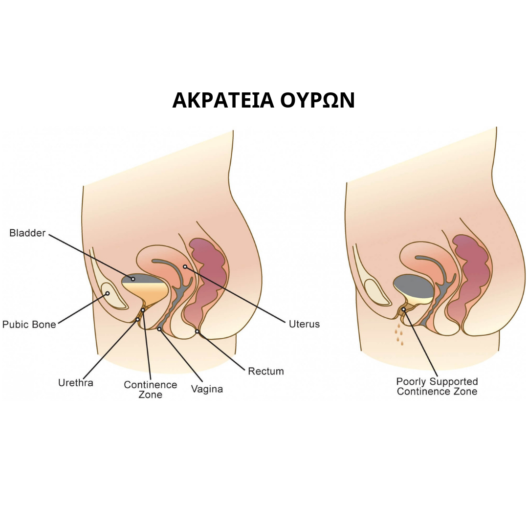 Ακράτεια Ούρων και Φυσικοθεραπευτική Παρέμβαση